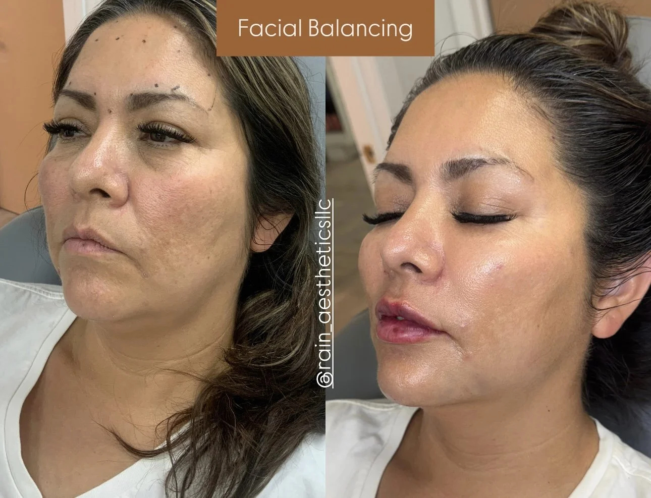 Facial balancing with dermal filler before and after at Rain Aesthetics in Glendale, AZ, showing enhanced cheek, chin and jawline proportions.