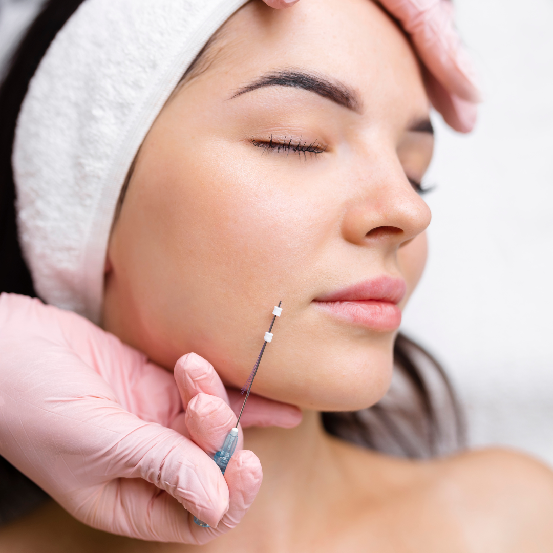 PDO thread lift of the cheeks and jawline at Rain Aesthetics in Glendale, AZ.