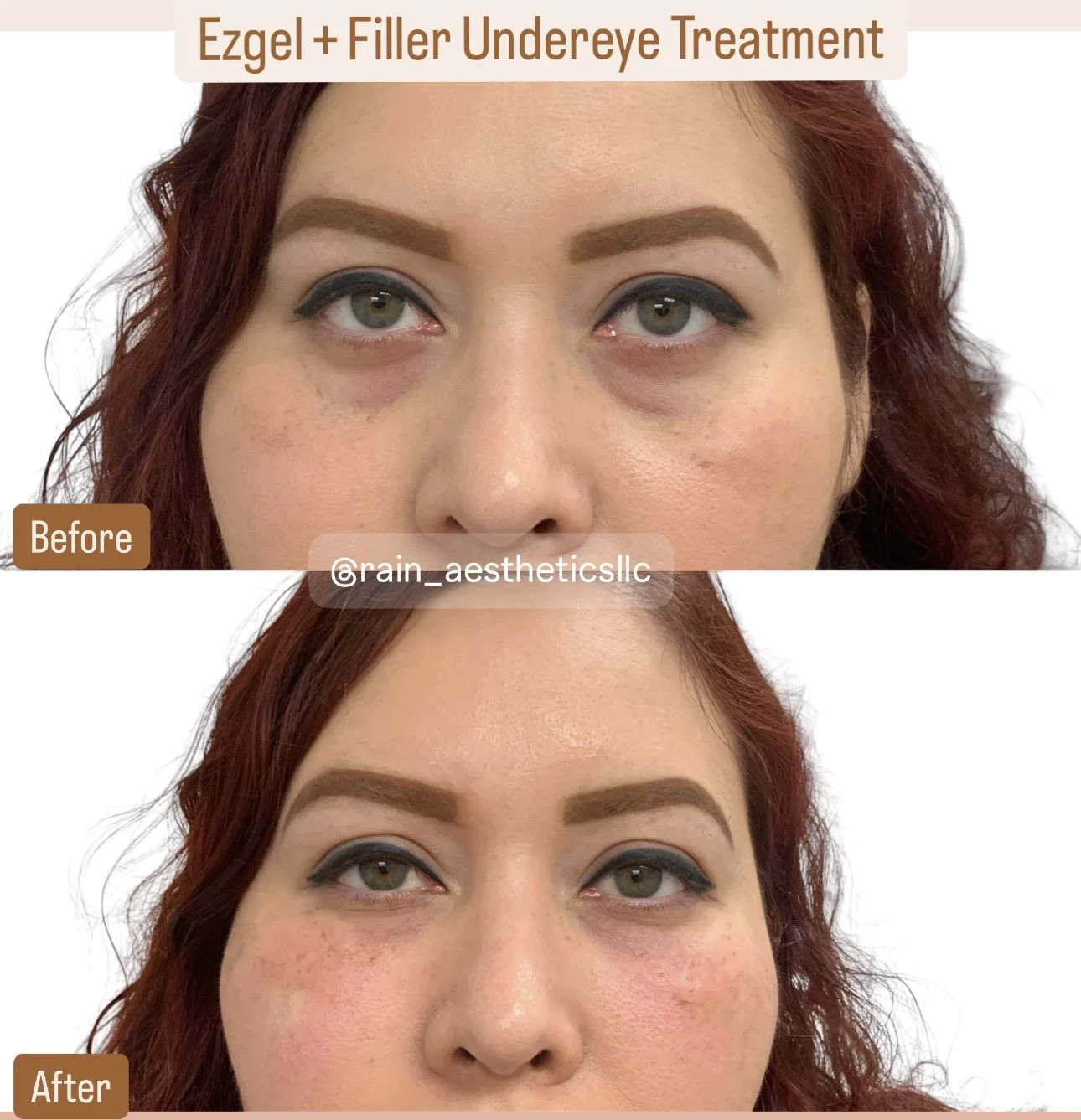 Before and after EZGel PRF under-eye treatment showing improvement in under-eye hollowness at Rain Aesthetics.