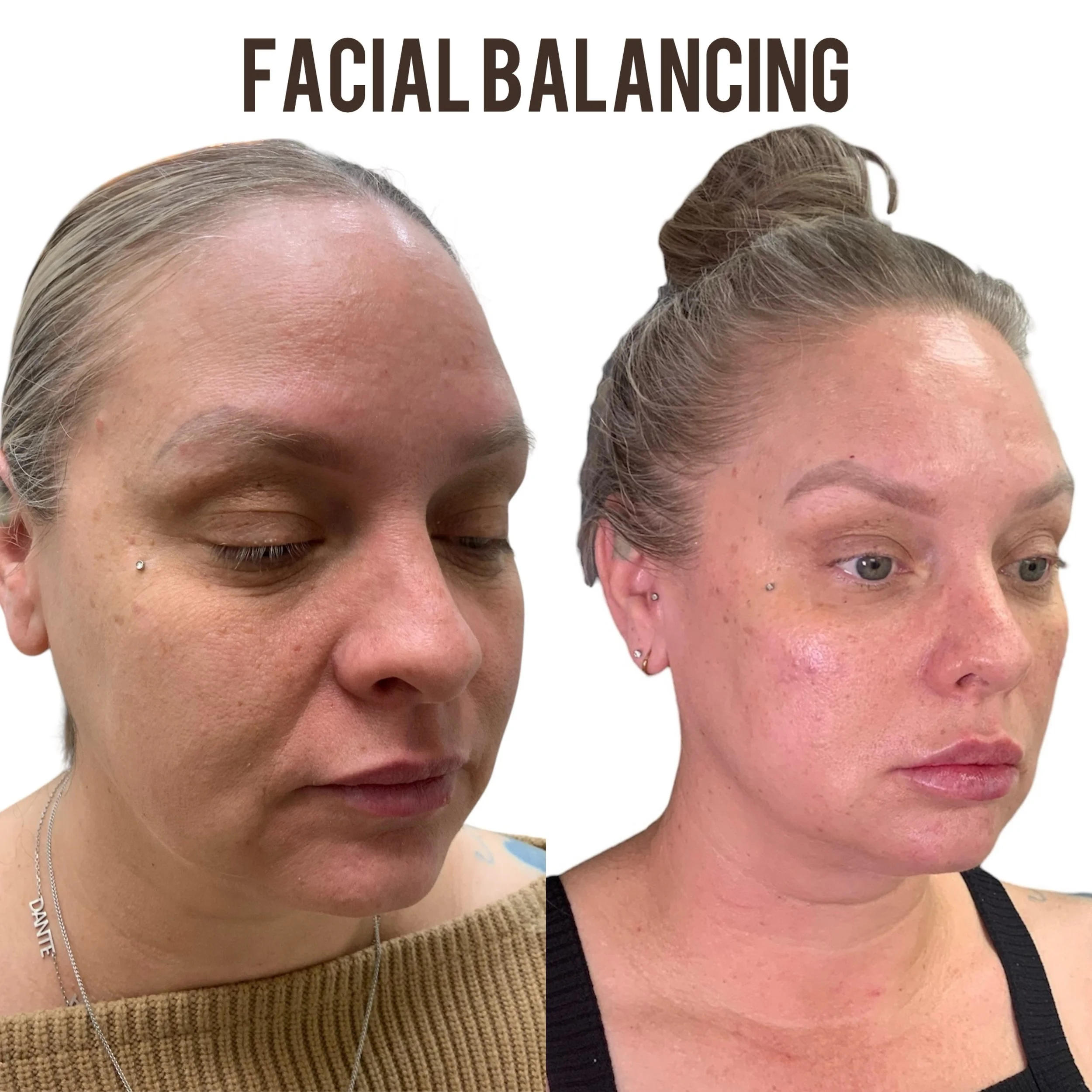 Facial balancing with dermal filler before and after at Rain Aesthetics in Glendale, AZ, showing enhanced cheek, chin and jawline proportions