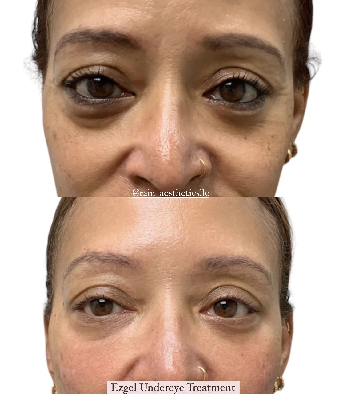 Before and after EZGel PRF under-eye treatment showing improvement in under-eye hollowness at Rain Aesthetics in Glendale, AZ.