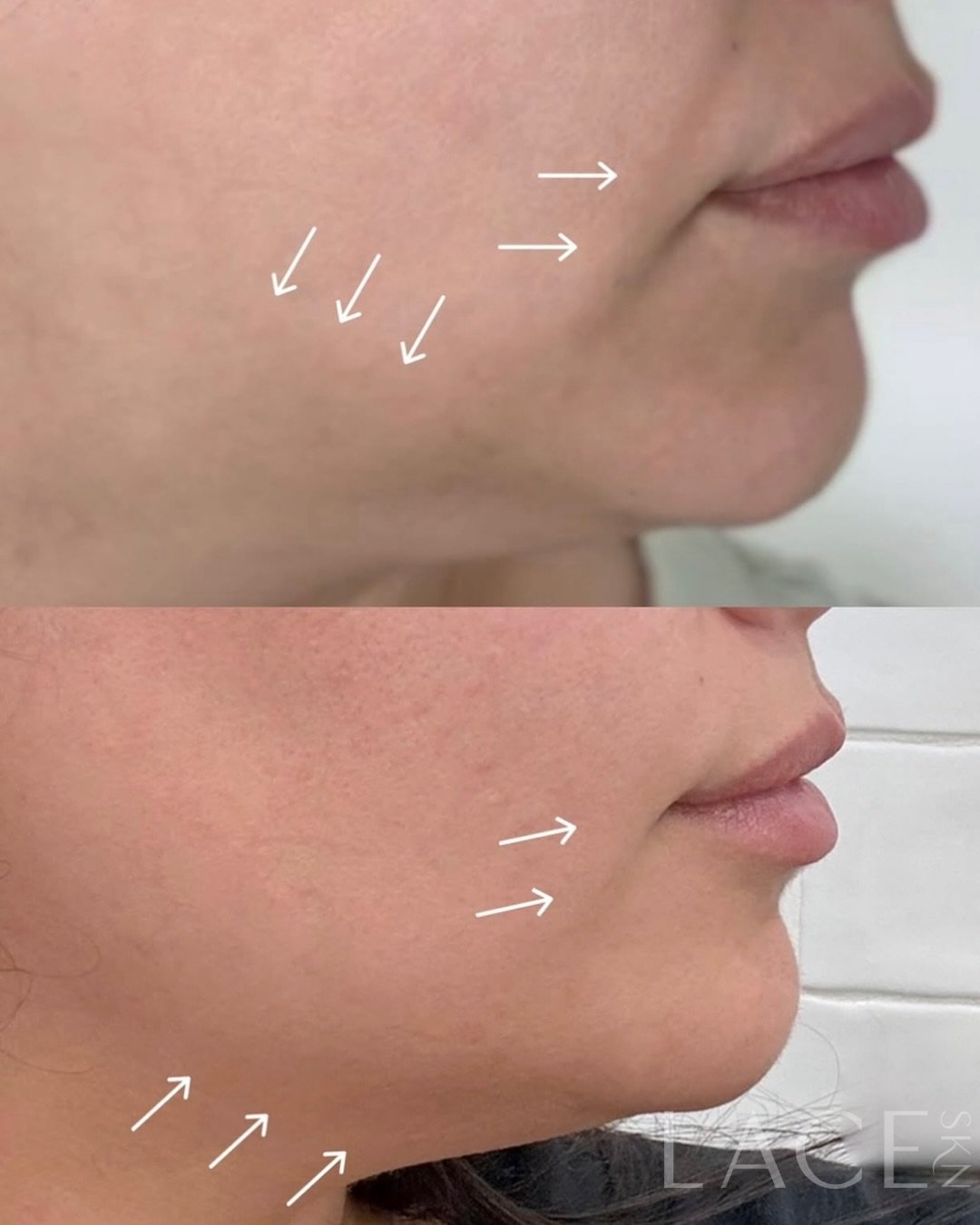 Bye-bye, bulldog jowls!🥹
Thanks to DAXXIFY and a little Lower Face Tox Lift we&rsquo;ve softened the downward pull, lifted the DAOs(muscles that pull sides of smile down), and said bye bye to jawline sag creating a smoother, more youthful profile. W