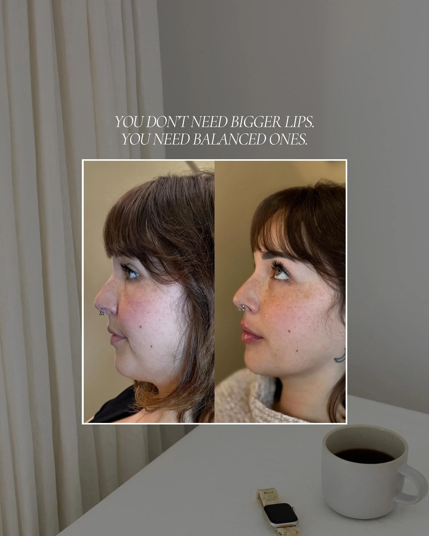 You want to enhance your lips, but you&rsquo;re nervous they&rsquo;ll look overdone. 💉

We get it. You&rsquo;ve seen results that don&rsquo;t feel natural, and the goal isn&rsquo;t &ldquo;different,&rdquo; it&rsquo;s balanced.

At Lace SKN, lip fill