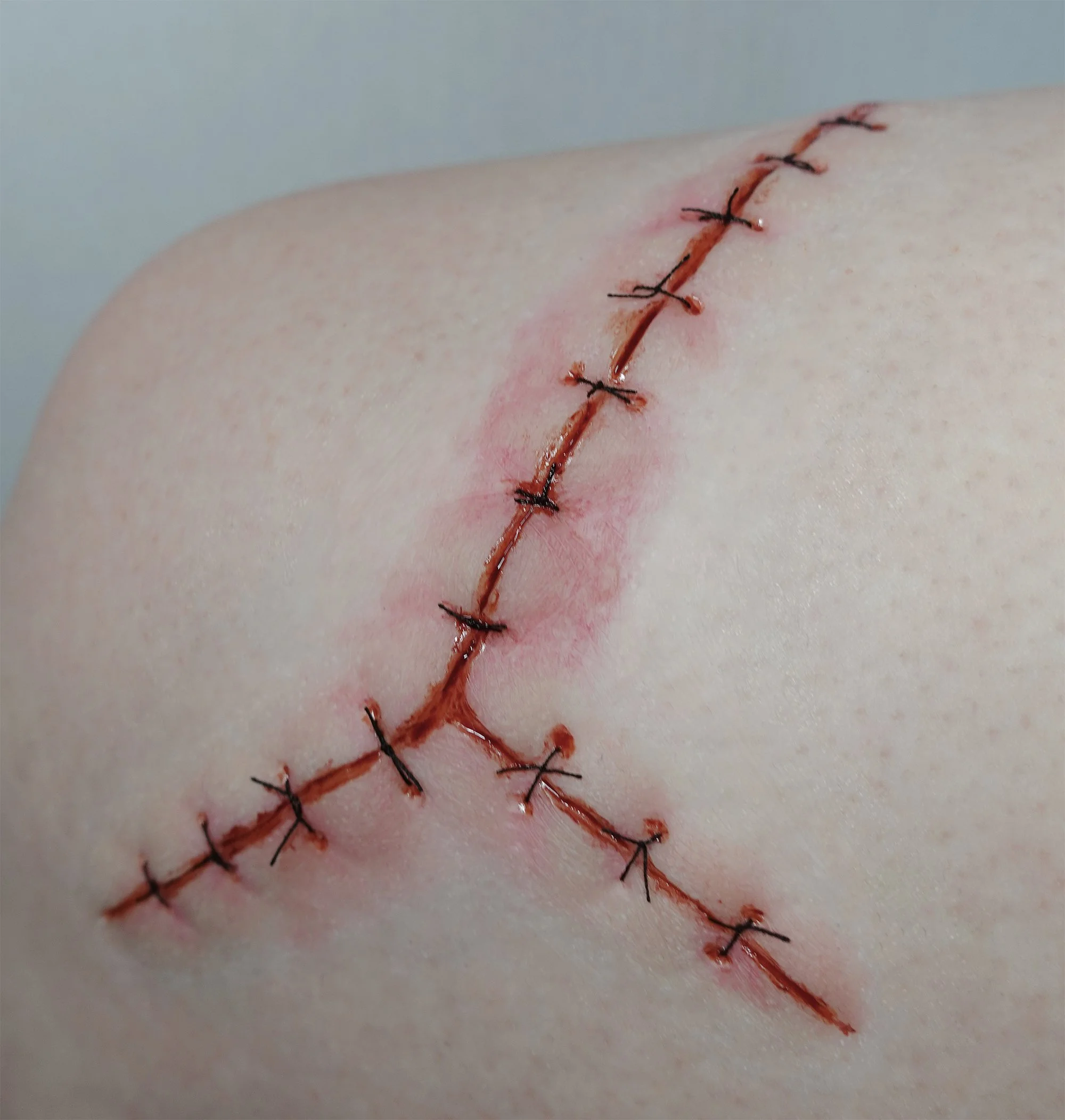 Long Suture Scar 4