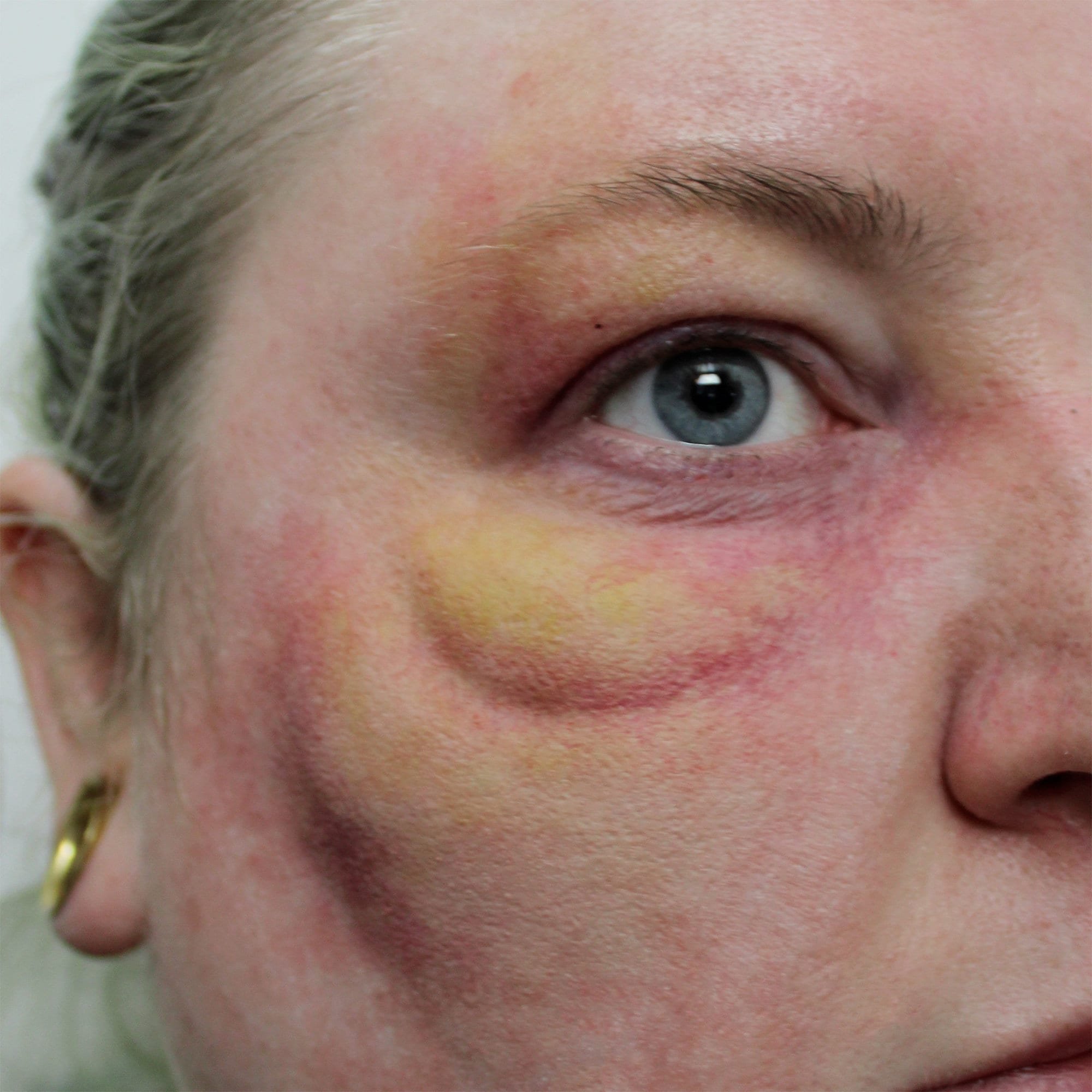 Swollen Eye and Cheek - Right Side