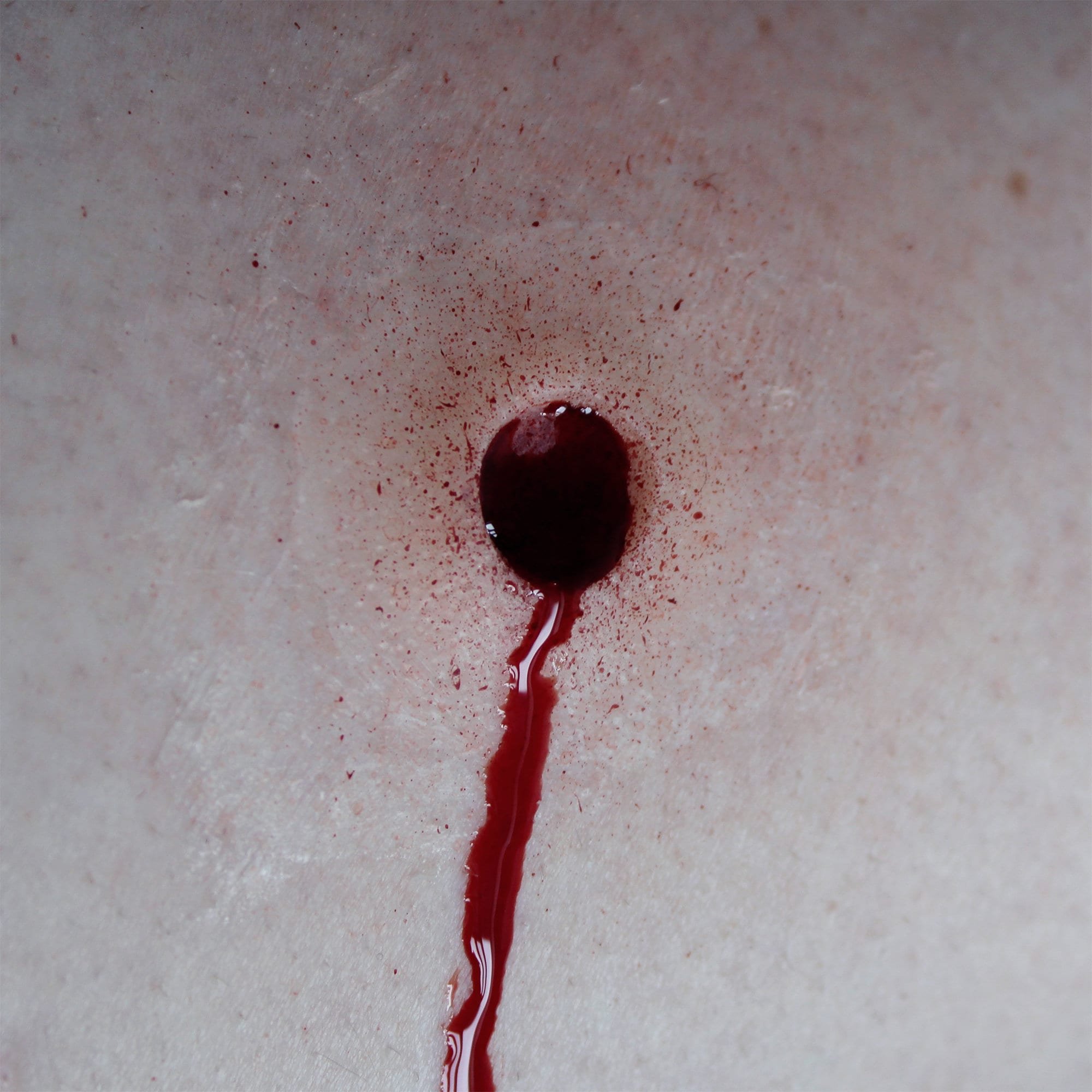 Gunshot Entry Wound 1