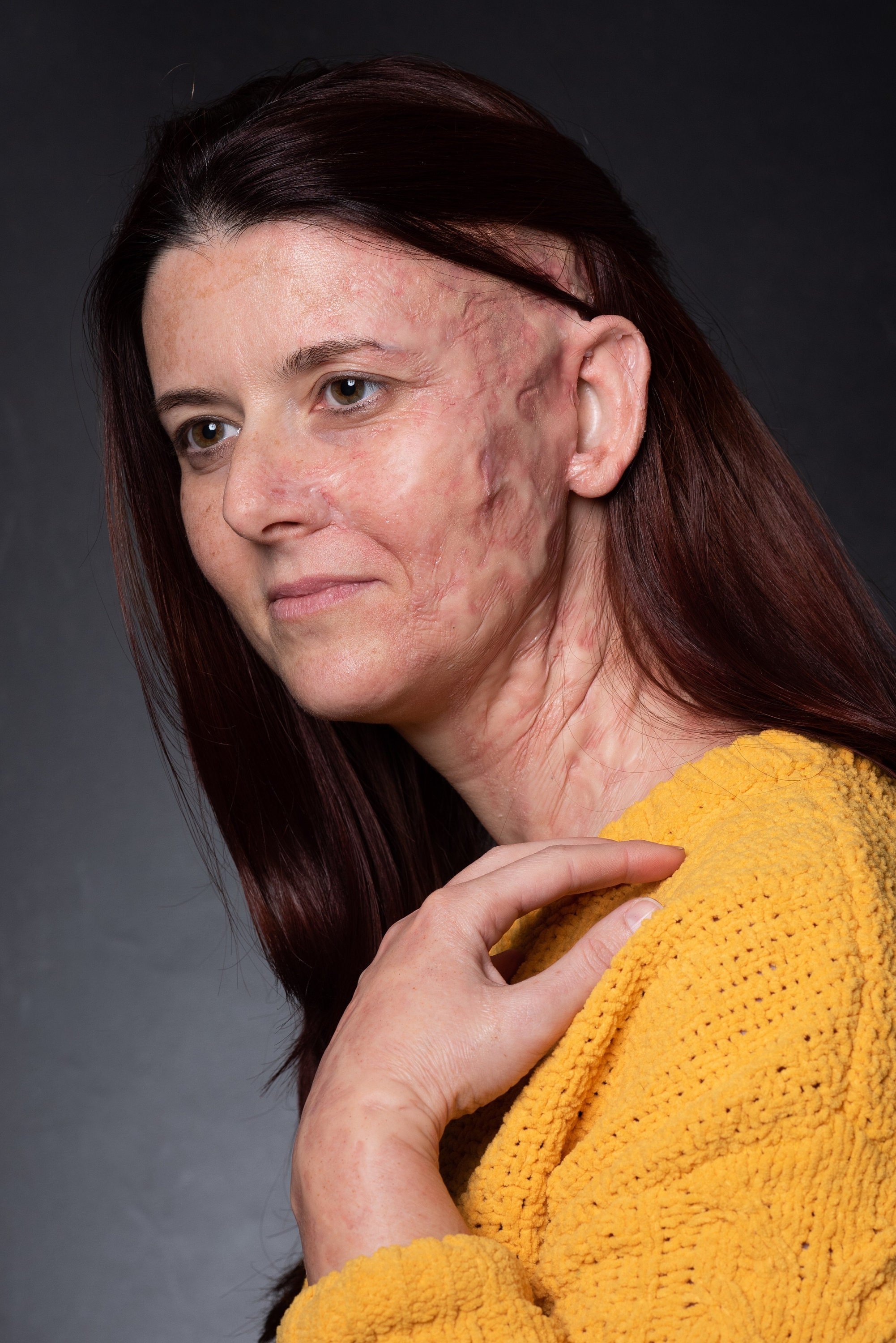 Burn Scars