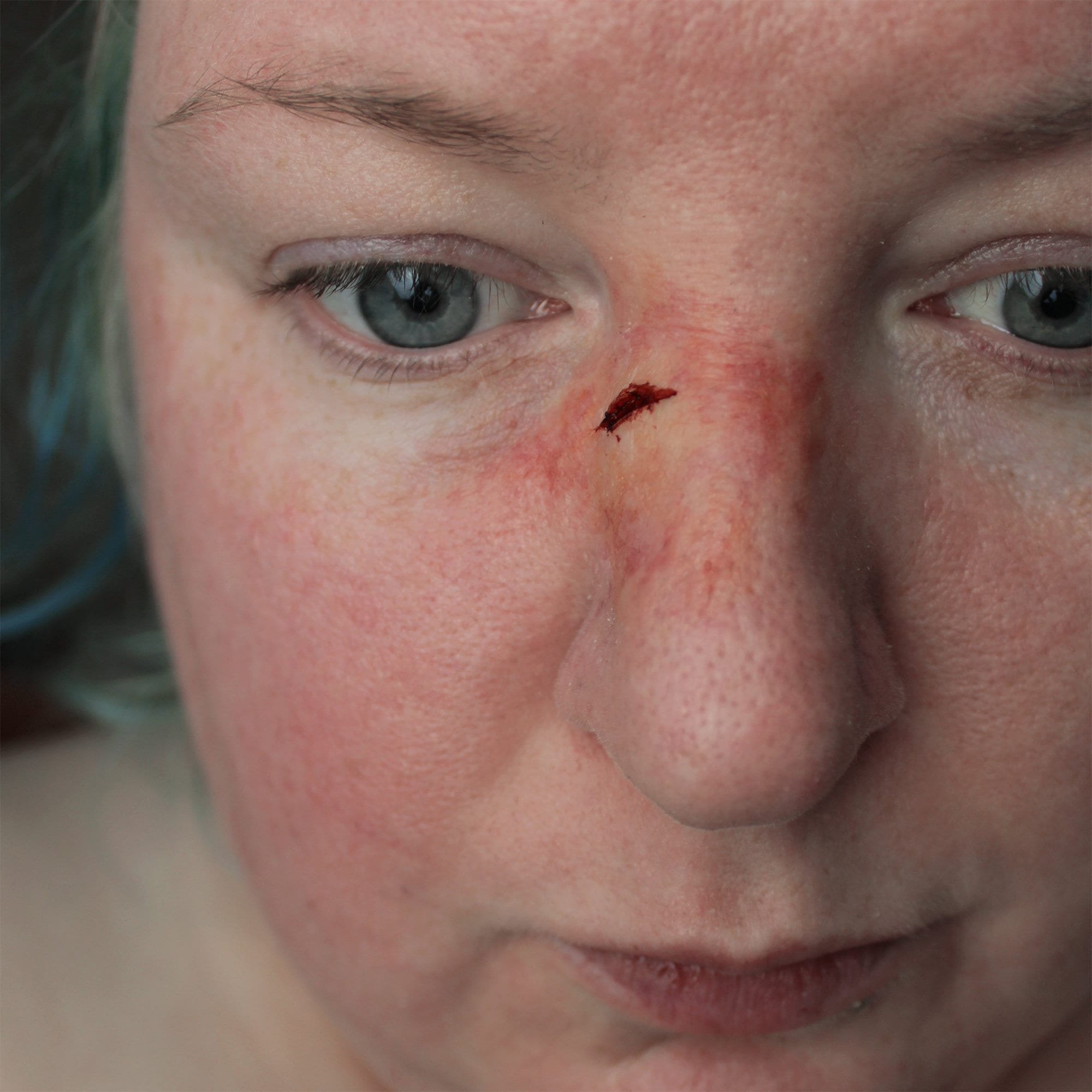 Broken Nose 2
