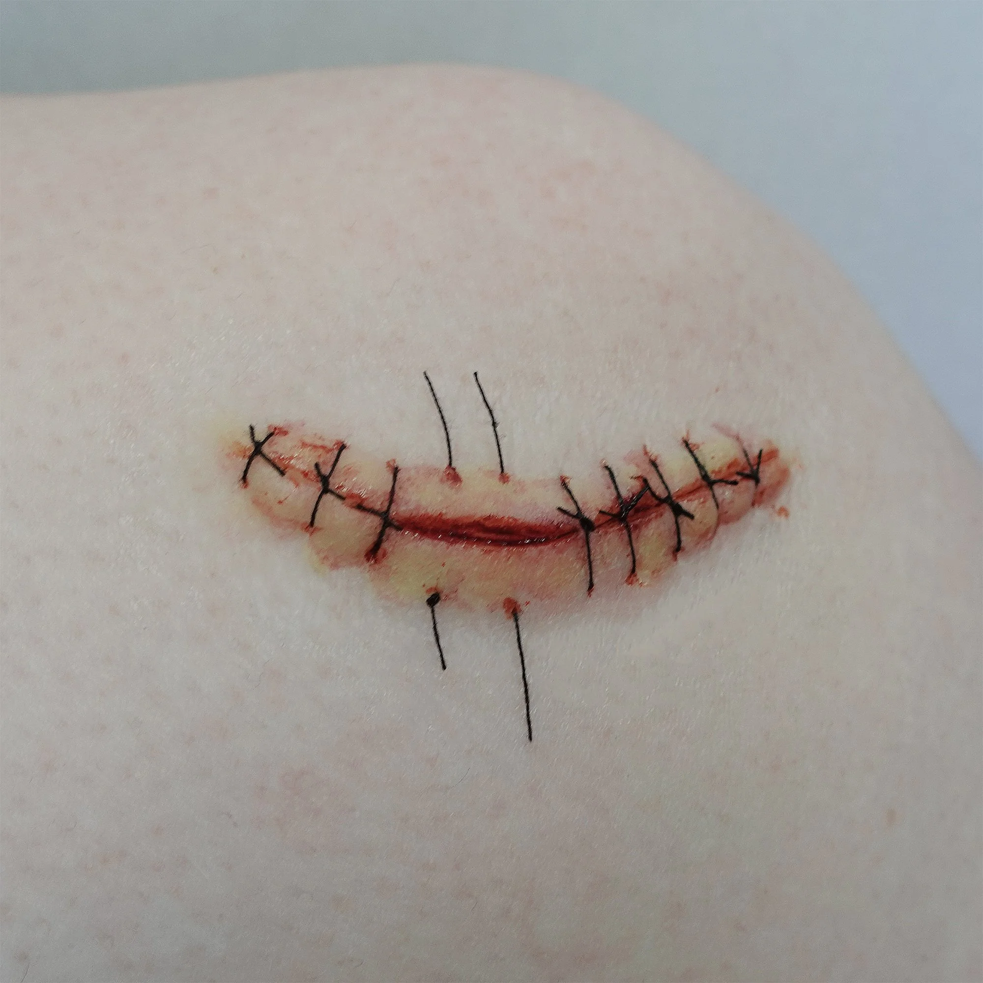 Small Burst Suture Wound