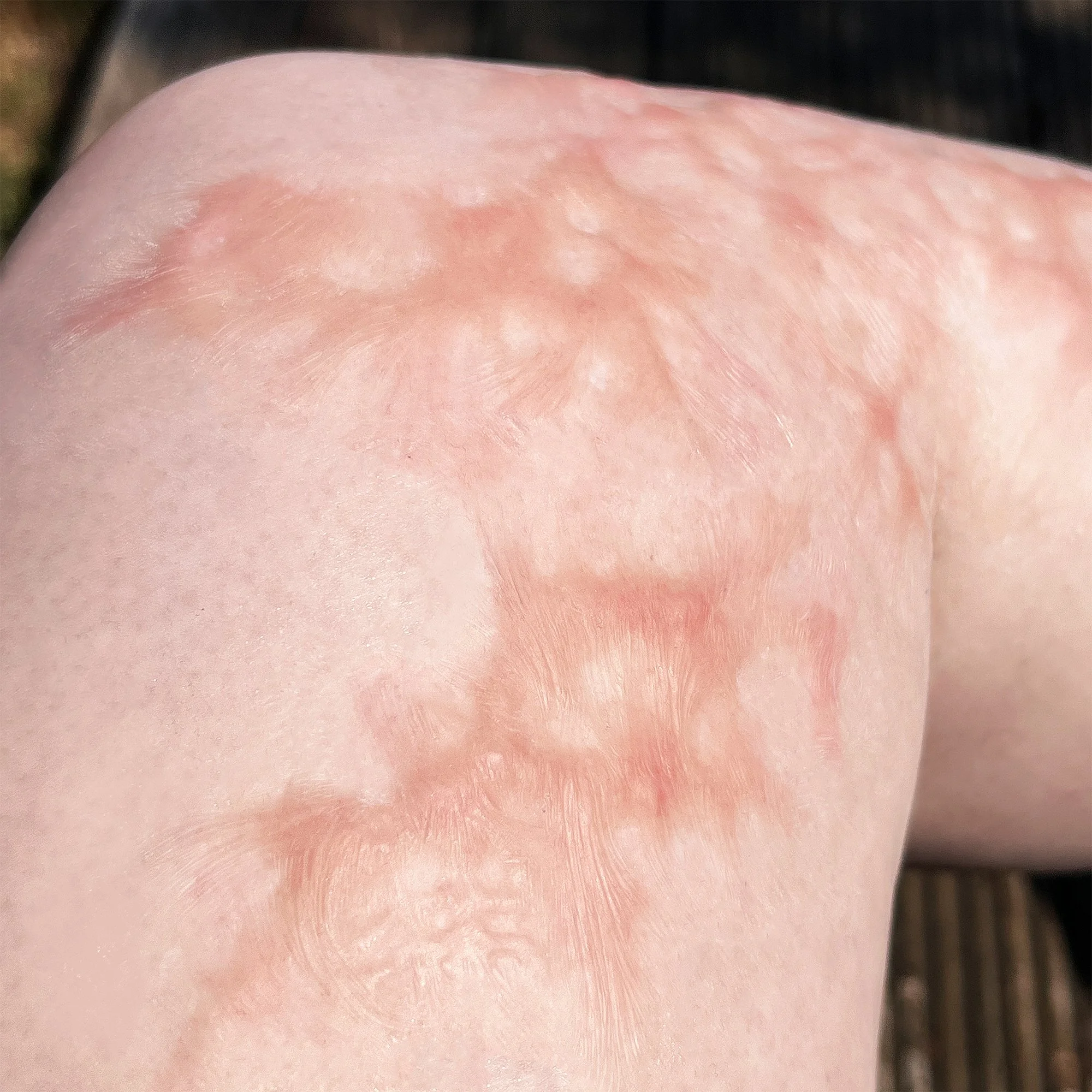 BurnScars2App2.jpg