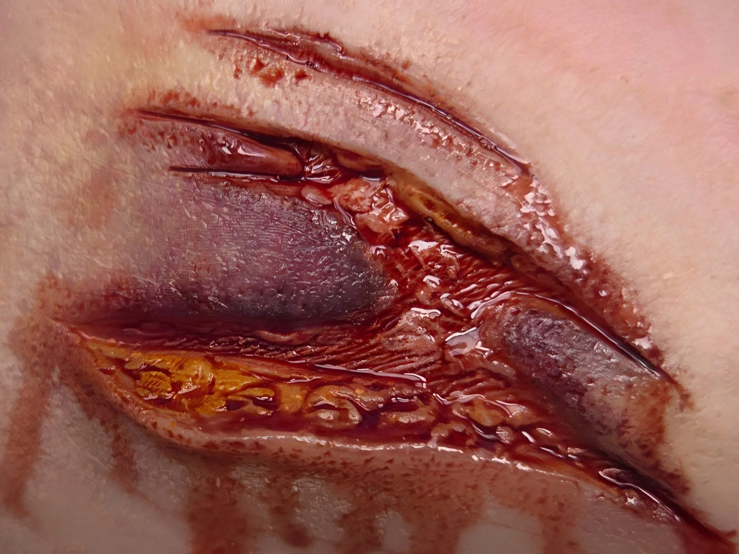 Meaty Wound 2