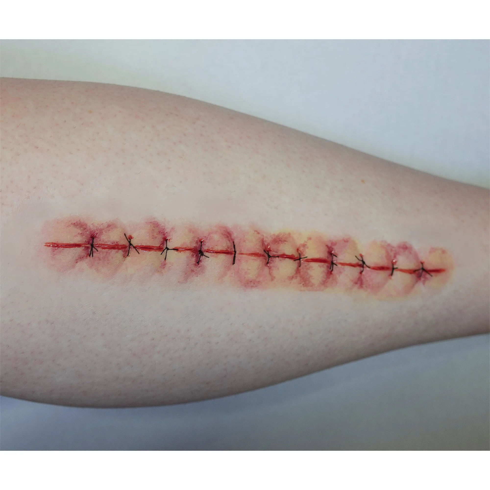 Long Suture Scar 2