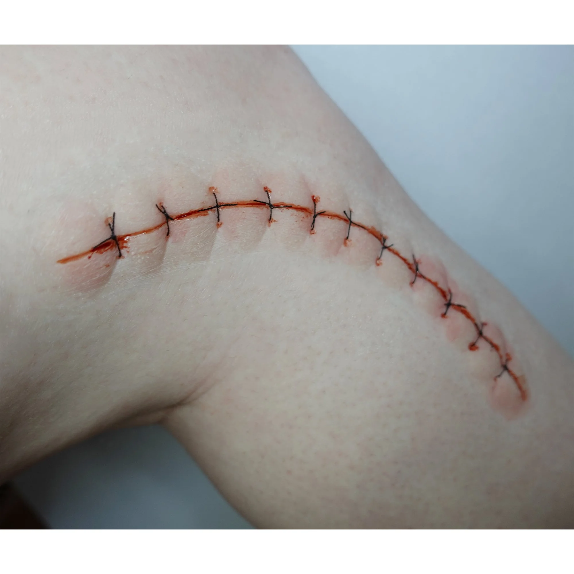 Long Suture Scar 3