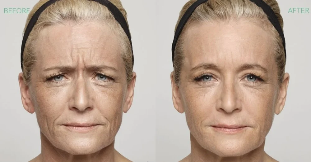 Injectables — Spoiled Rotten Cosmetic Studio