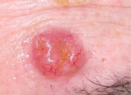 Close-up of a human skin lesion with redness, yellowish crust, and visible blood vessels.
