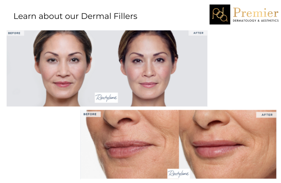 Restore Volume and Youth with Dermal Fillers in NYC