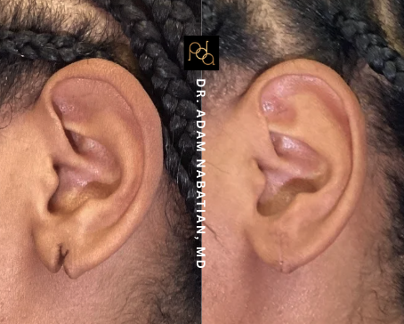 Earlobe Repair in NYC: Restore Torn or Stretched Earlobes