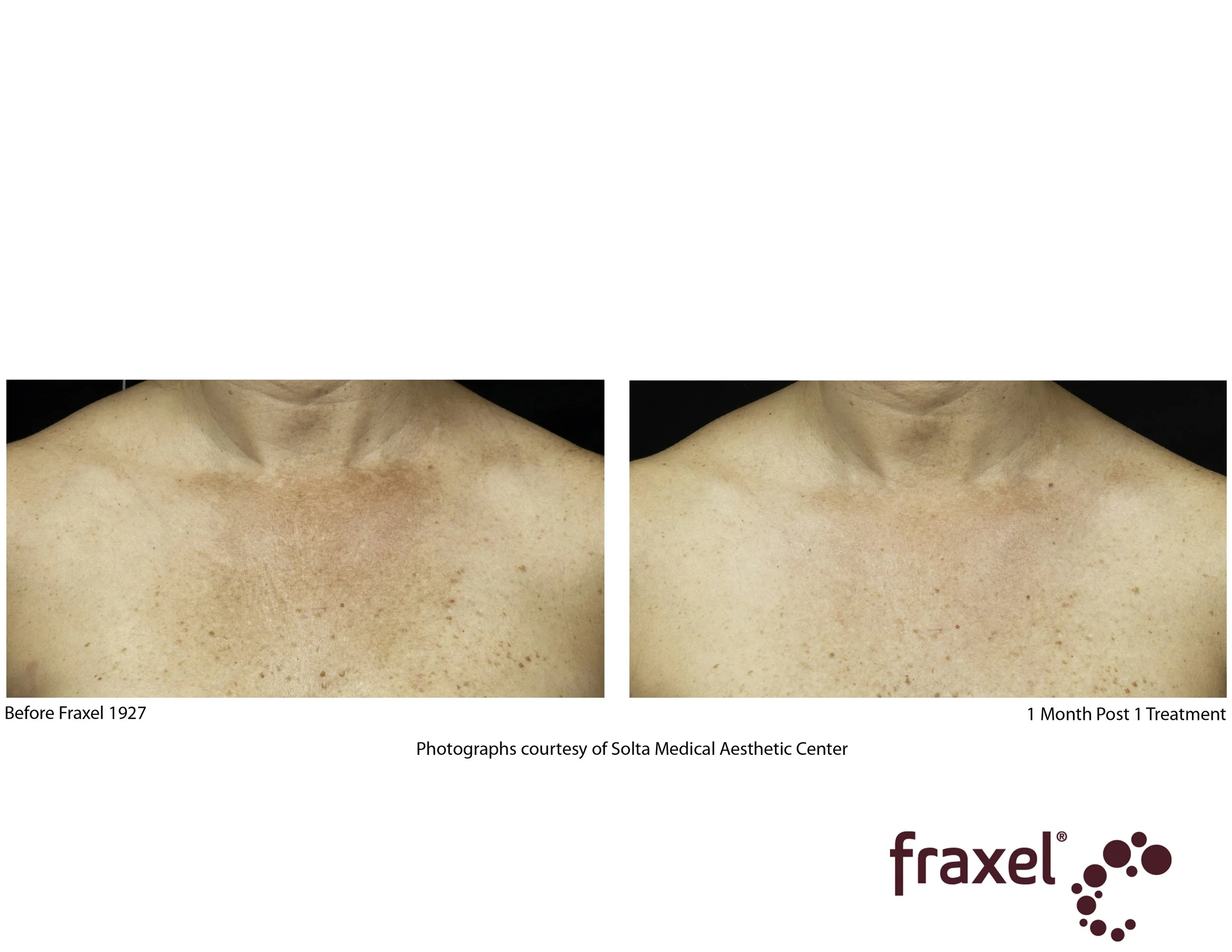Everything You Need to Know About Fraxel Dual Laser Treatment in NYC