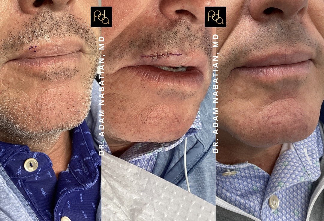 Mohs Micrographic Surgery in NYC: The Gold Standard for Skin Cancer Treatment