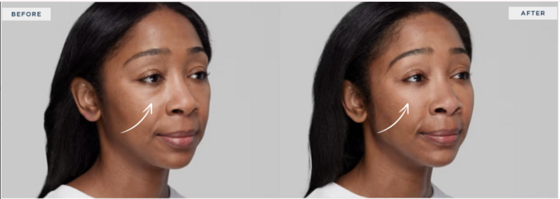 Facial Rejuvenation With Filler in NYC