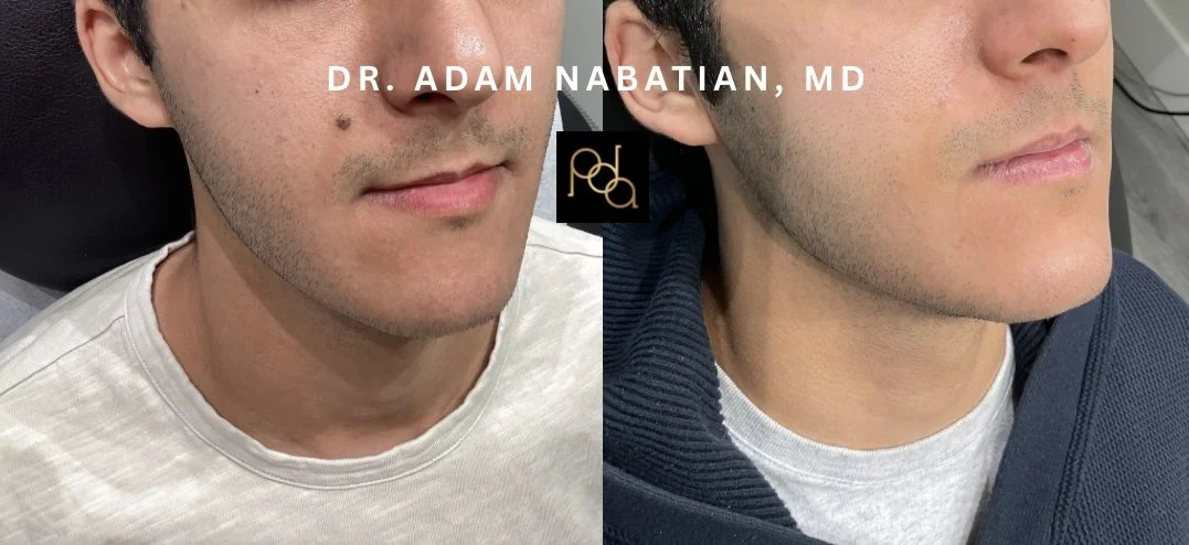 Cosmetic Mole Removal in NYC: Safe, Precise, and Natural-Looking Results