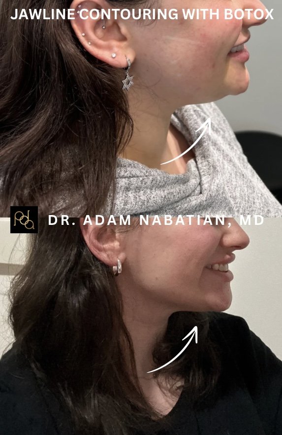 BOTOXTMJ BEFORE AND AFTER(1).jpeg
