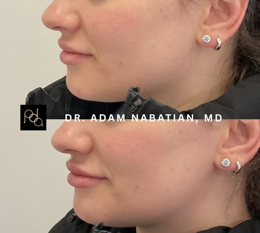 Lip filler before and after.jpeg