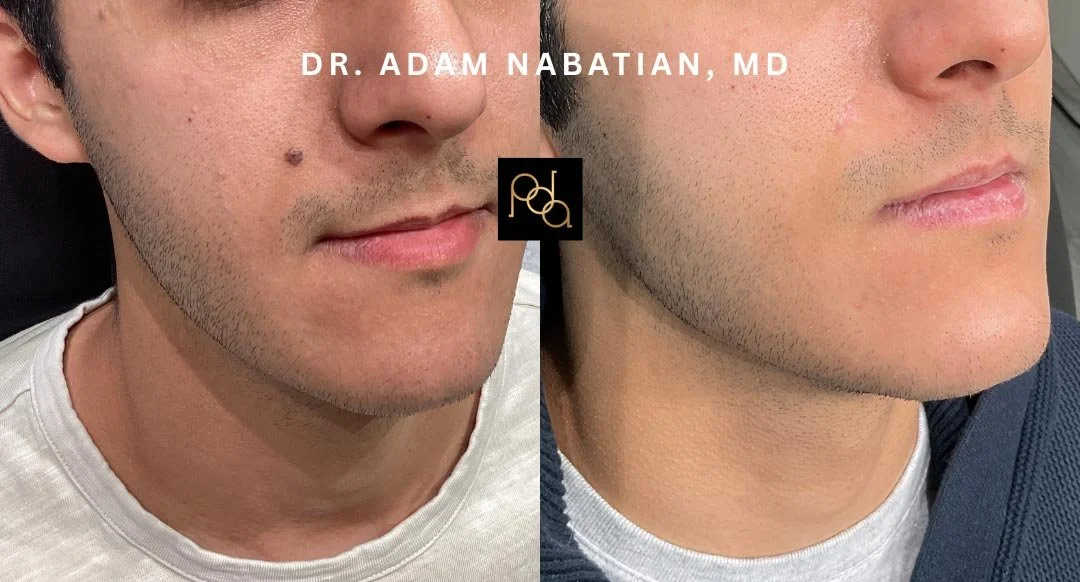 Side-by-side close-up photos of a man's lower face showing improved jawline and skin texture after cosmetic treatment, with text overlay of Dr. Adam Nabatian, MD.