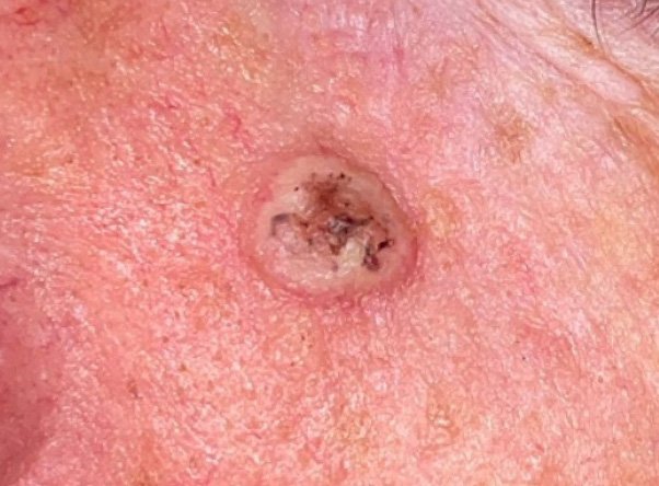 Close-up of a nose with a blackhead or clogged pore.