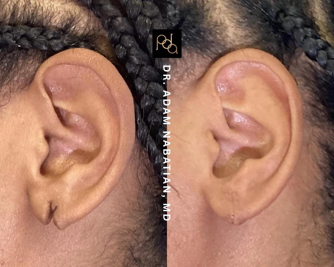 EARLOBE-REPAIR-BEFORE-&-AFTER.jpg