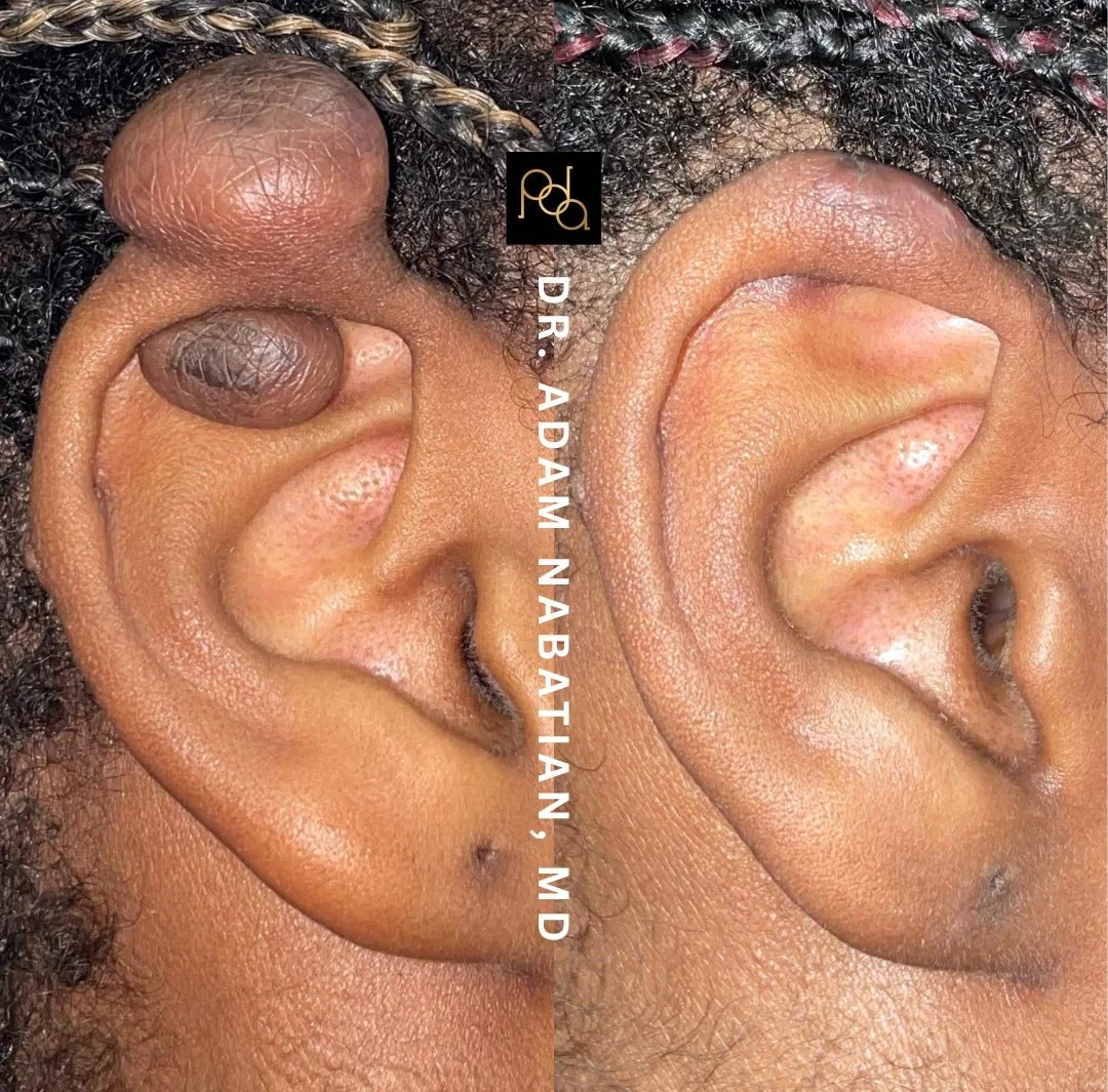Close-up of two human ears, one with a large cyst or growth and the other normal, showing a before-and-after comparison from a medical procedure by Dr. Adam Nabatian, MD.