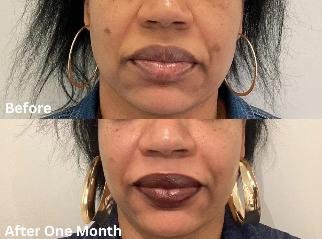 Close-up of a woman's face showing spot treatments and lip gloss, before and after one month of treatment.