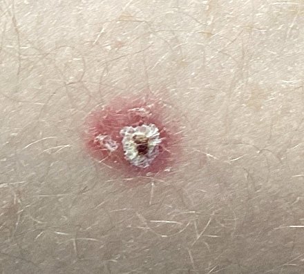 Close-up image of a small skin wound or sore with some redness and a white substance in the center.