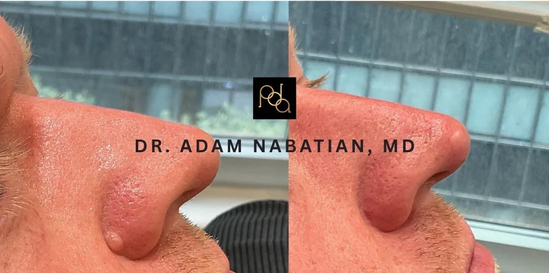 Close-up side view of a nose before and after a cosmetic procedure, showing improvements in skin texture and shape, with the text 'Dr. Adam Nabatian, MD'.