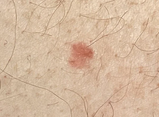 Close-up image of a small, red, inflamed skin lesion on human skin with fine hair.