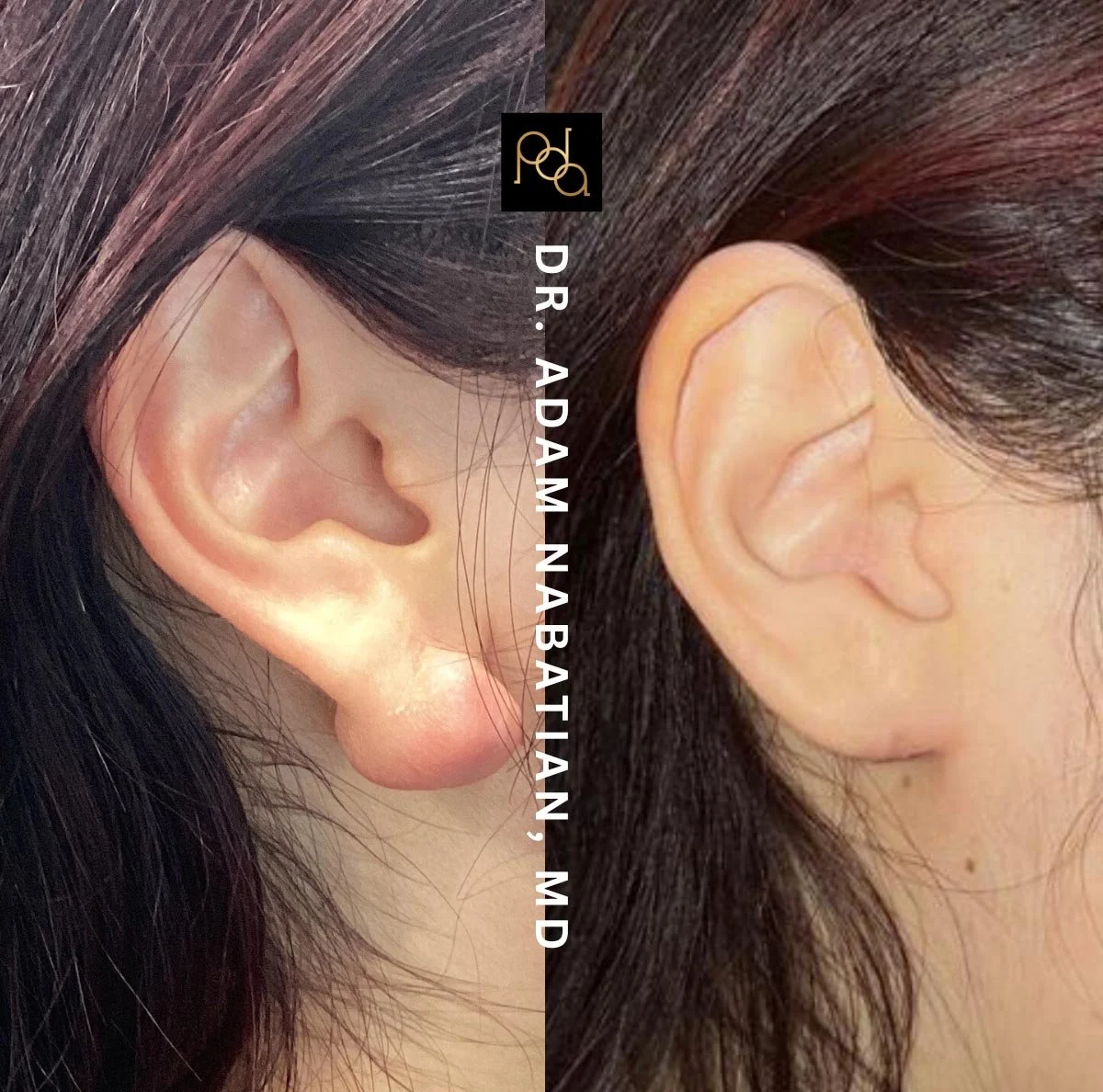 Close-up images of two different ears with dark hair, with the text 'Dr. Ada M. Nababtian, MD' in the center.