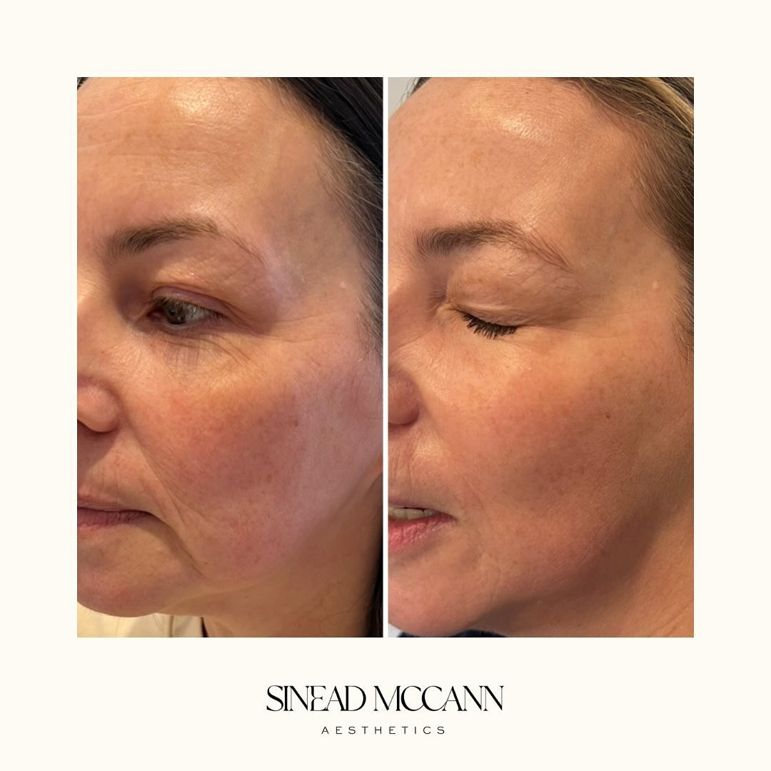 L O N G  G A M E 

&bull;

2 years in and ageing in reverse. A combination of treatments focussing on skin health (and a teeny bit of filler and tox) Microneedling, profhilo, polynucleotides and chemical peels. Regular treatments to maintain great re