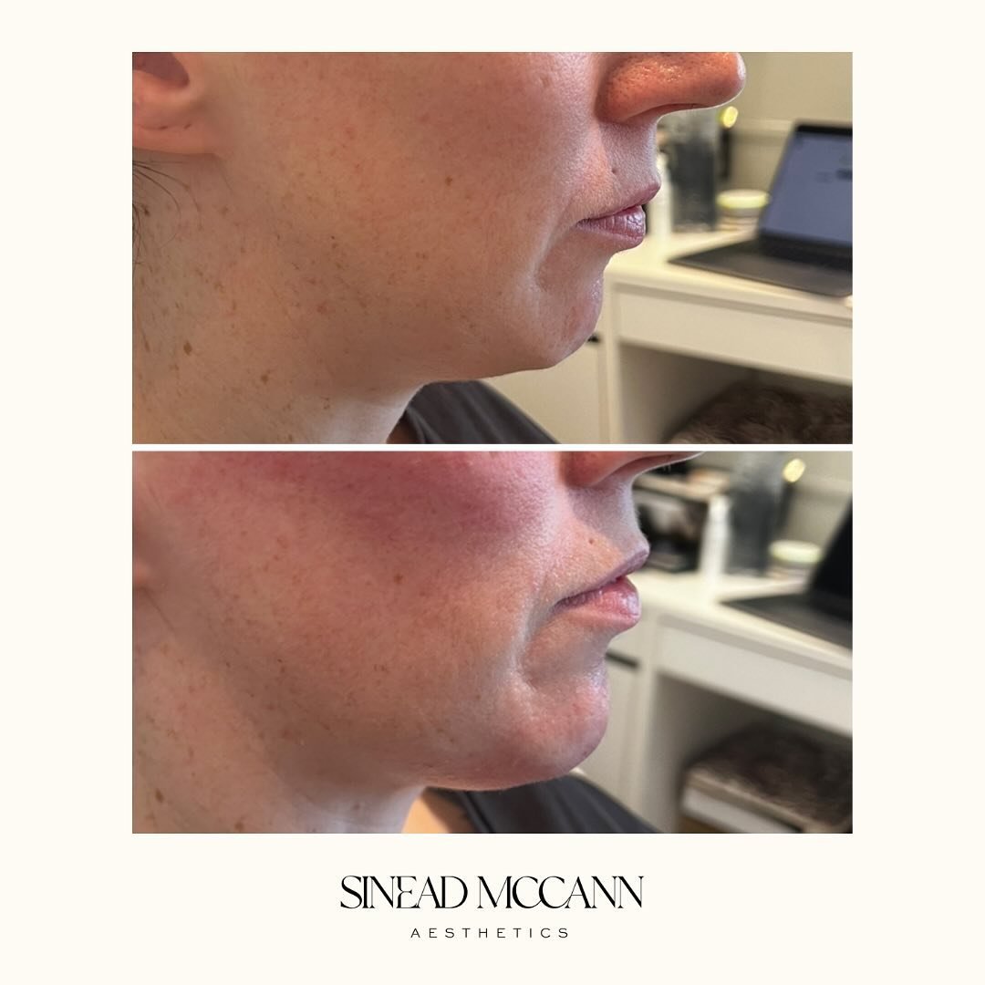 T I N Y  T W E A K 

&bull;

Small amounts of filler placed effectively can have such an impact. Here we&rsquo;ve used a small amount of @teoxane_uk RHA4 to balance the profile. 

Book through the link in our bio to see what tiny tweaks could do for 