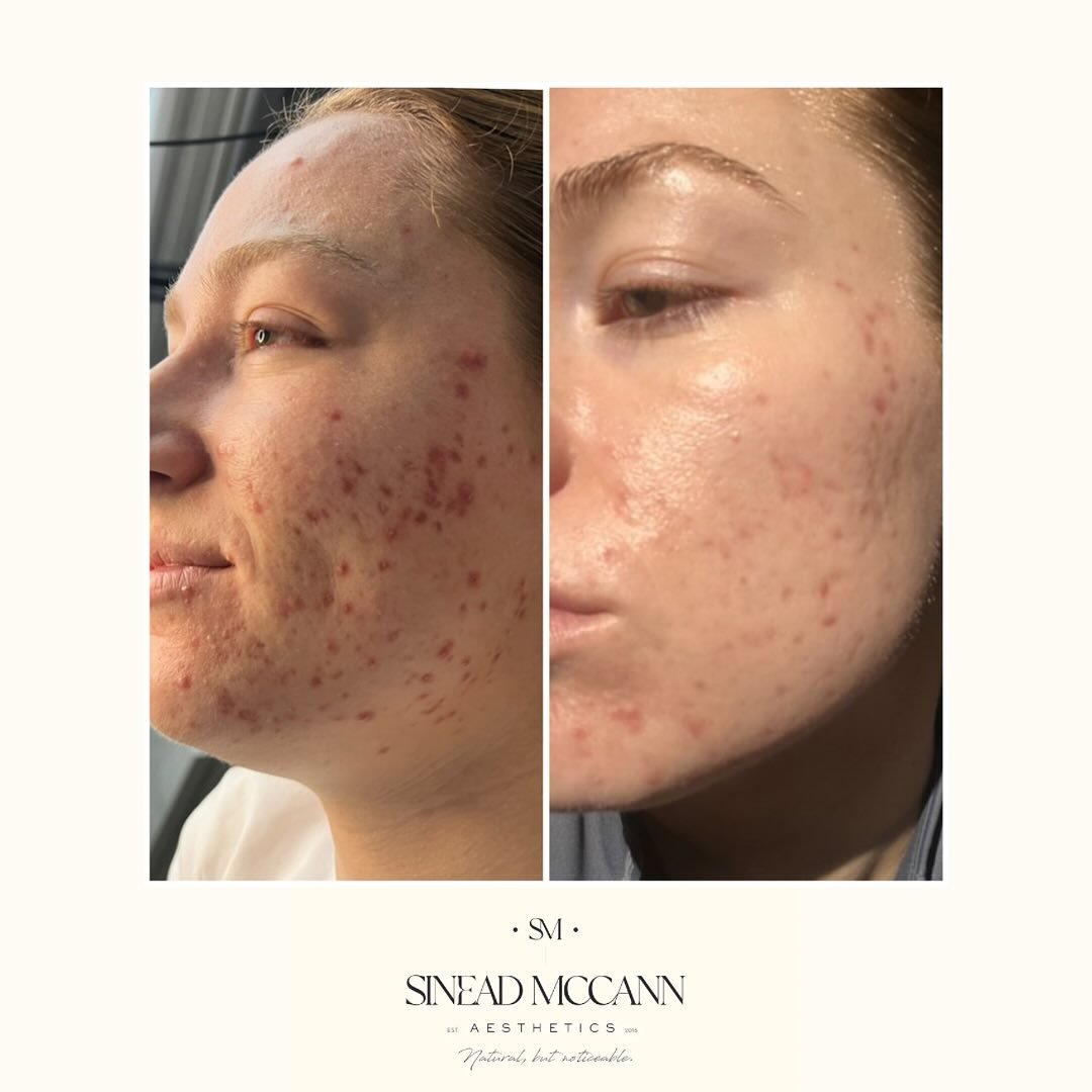 C H E M I C A L P E E L S
•
A course of @pcaskin_uk chemical peels to achieve this amazing result. Cystic breakouts have settled, post inflammatory erythema has reduced and we’ve now started a course of SkinPen Microneedling to tackle