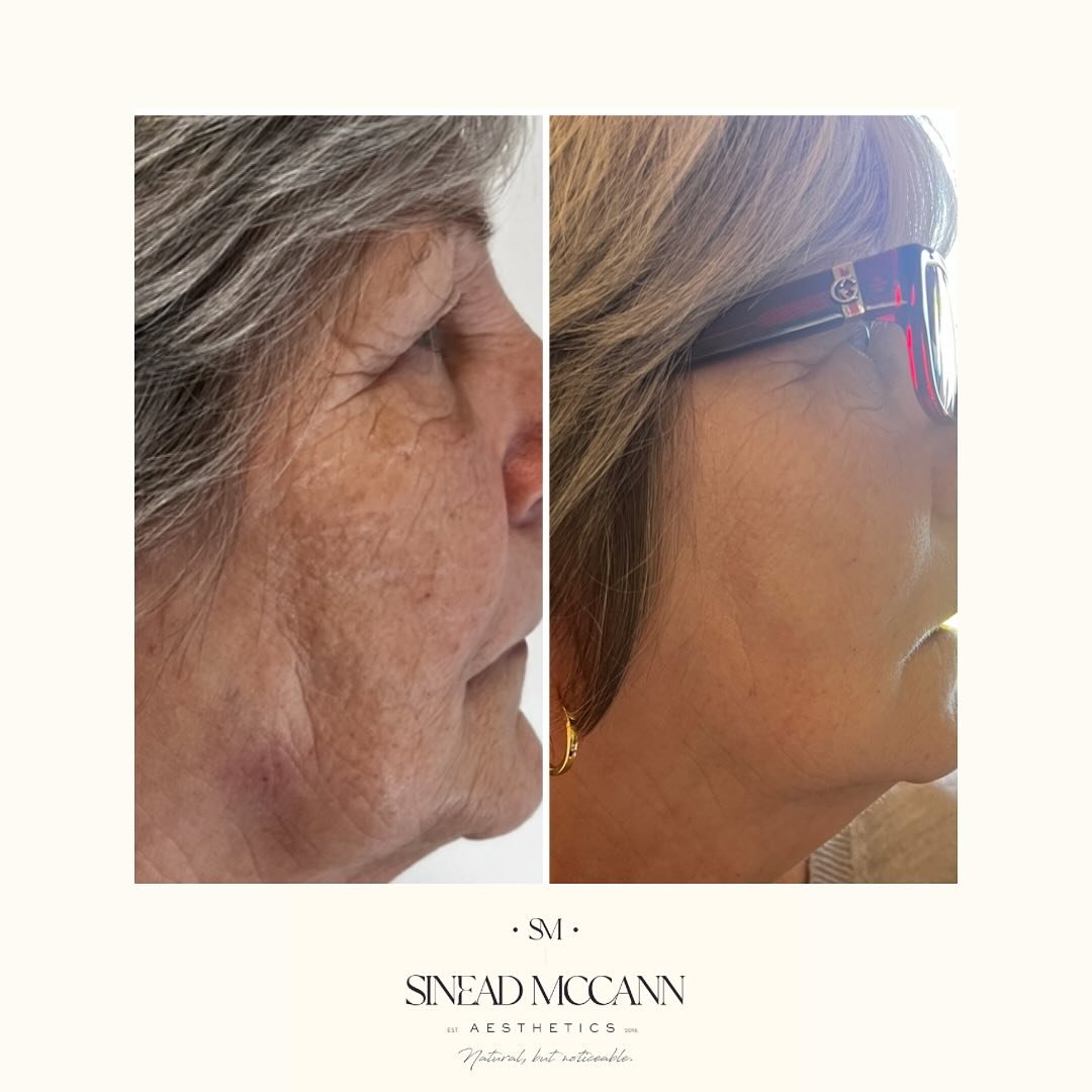 R A D I E S S E
•
The filler with a difference.
Radiesse is a calcium hydroxyapatite. This has an immediate improvements but best results are seen over the next 6 - 8 weeks, as it promotes collagen and elastin production as it breaks down.
