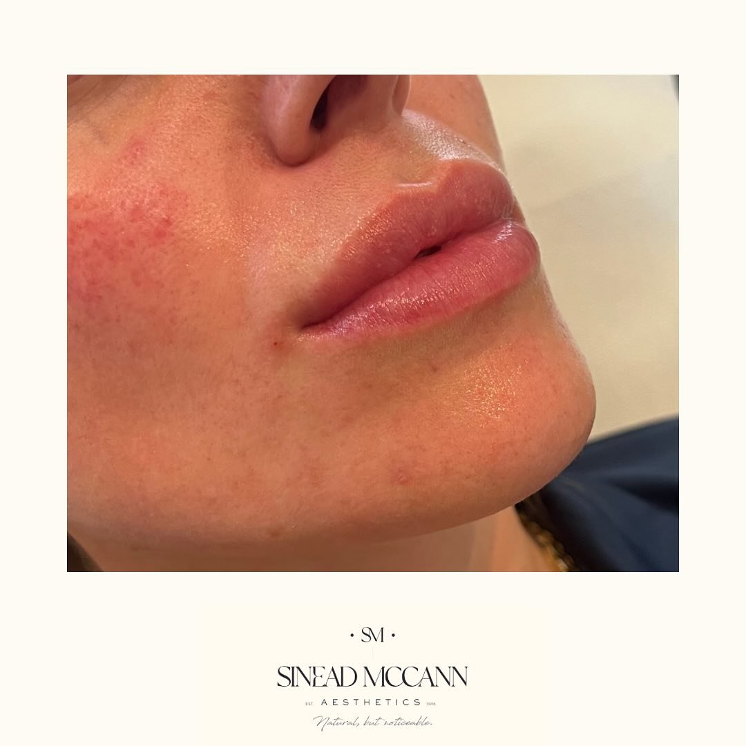 H Y D R A T I O N
•
If your lips are already incredible, but you just want a little added hydration, @teoxane_uk RHA1 is perfect for you. Lip rejuvenation rather than lip filler, you’re left with hydrated lips, without lots of added vol
