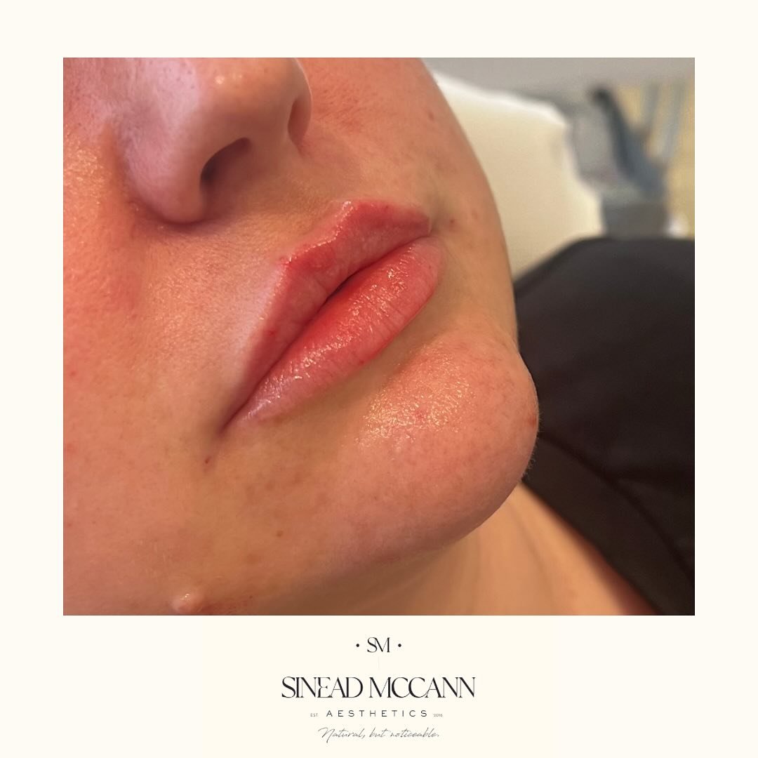 L I P S
I’d fallen out of love with lip treatments a little bit recently. No real reason why, you just lose your spark for things sometimes. But a refresher day has restored my love for all things lips 👄
@teoxane_uk RHA2 to refresh, add de