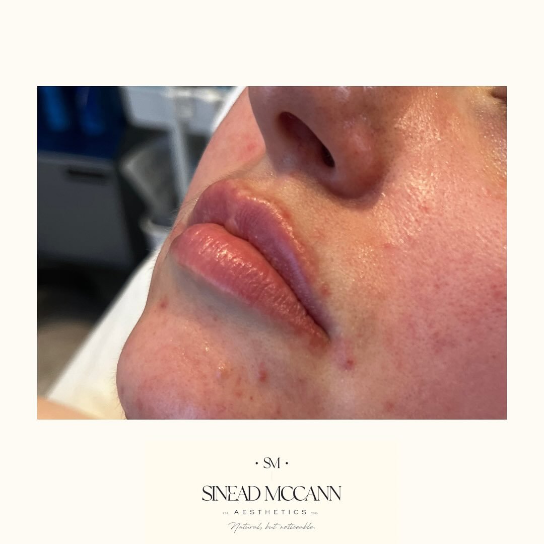 A subtle refresh with @teoxane_uk RHA Kiss 💋
#lipfiller #naturalbutnoticeable #aesthetics #skinclinic #medicalskinclinic #refresh #rhakiss #suttoncoldfield #meregreen