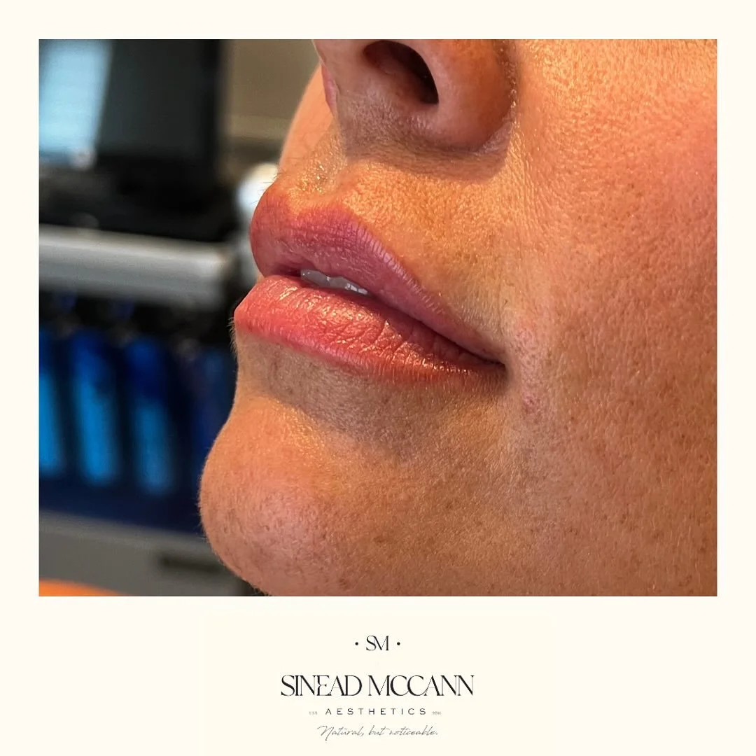 RHA1 for subtle hydration. Can you believe she has no lipstick or lip blush on these - it’s just her natural pigment. How does it feel to be gods favourite? π
.
If you love your lips but just feel they’ve become a little flatter, almos