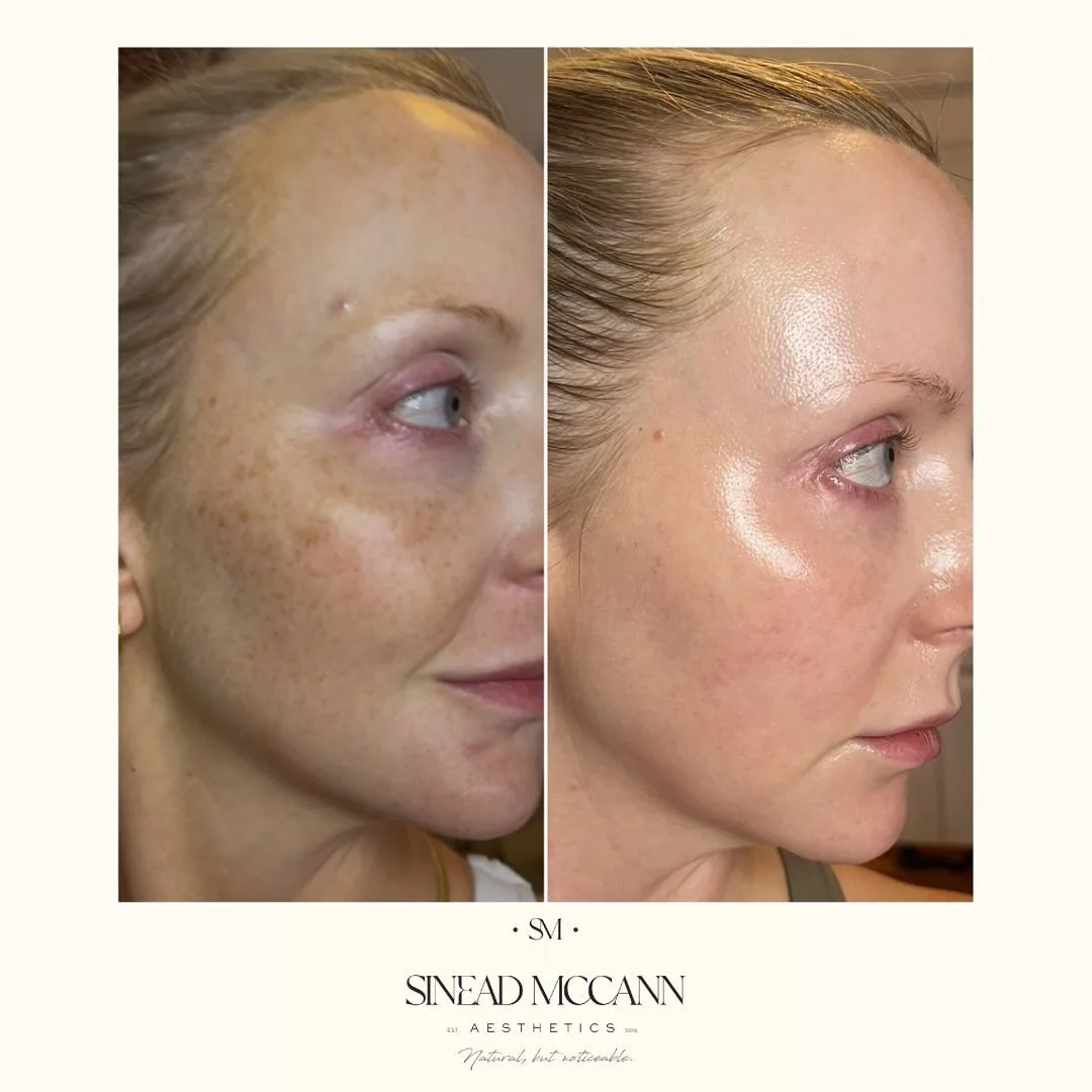 K L I R A 

&bull;

I have battled hyperpigmentation for YEARS. Sunbeds, tanning and only starting daily SPF in my early 30&rsquo;s left me with recurrent hyperpigmentation every summer. Enter @kliraworld. I introduced this to clinic and when they of