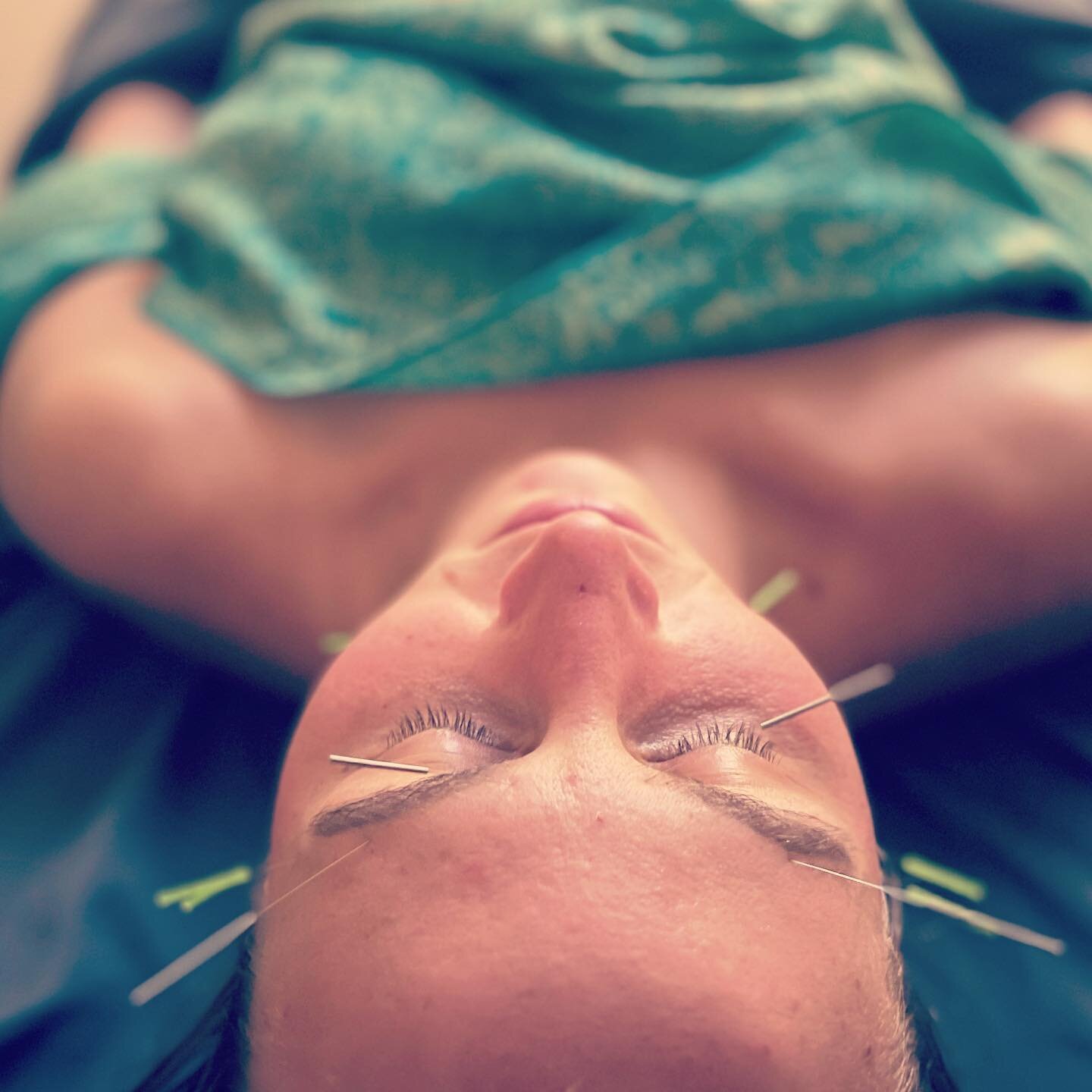 Facial acupuncture to relieve muscle twitches and headaches #ashipoints #facial-acupuncture #facialacupuncture