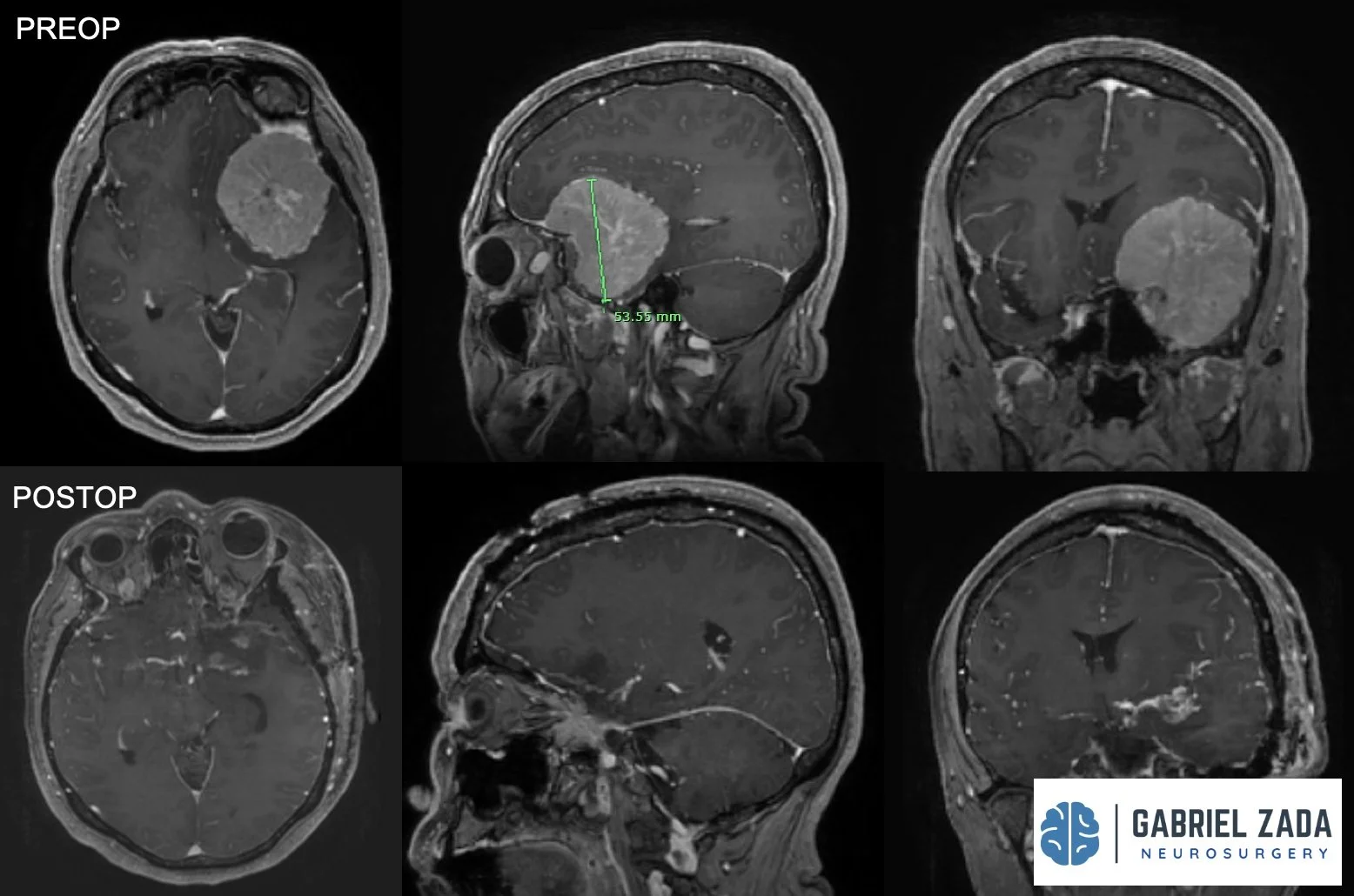 MENINGIOMA1.jpeg