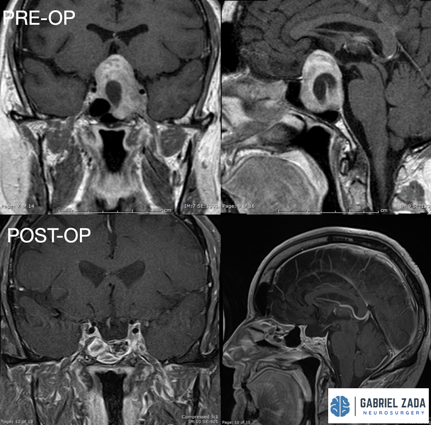 minimally invasive pituitary surgery
