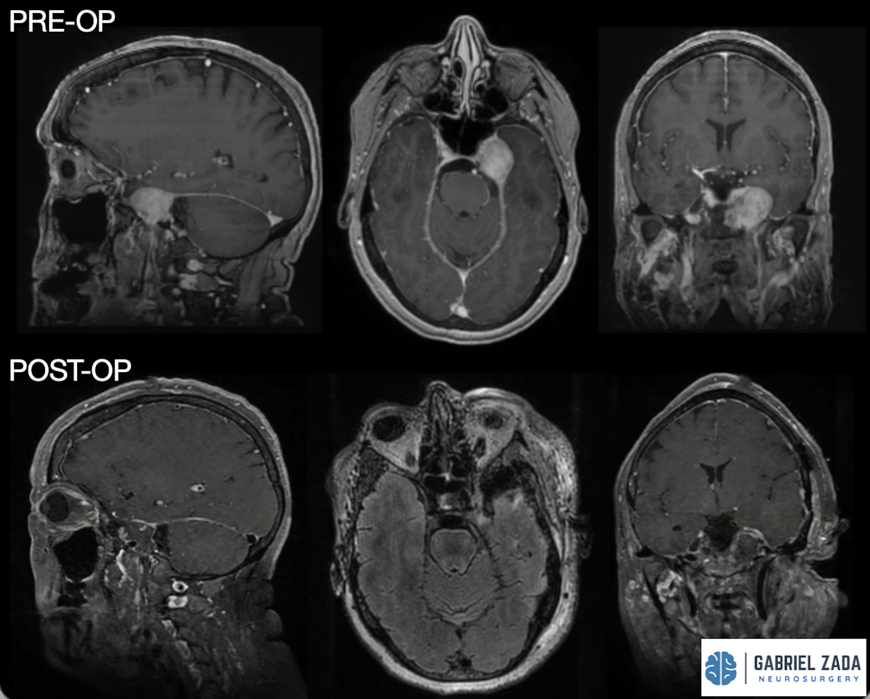 CHONDROSARCOMA surgery