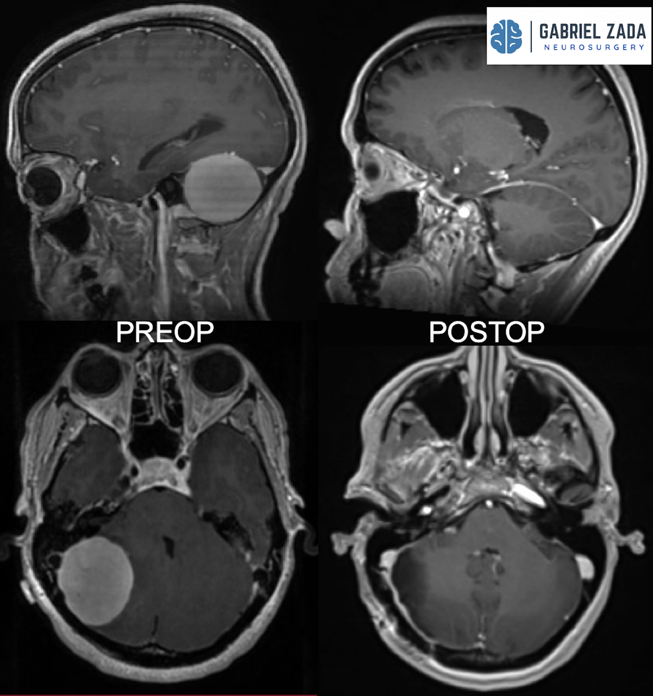 Meningioma Treatment